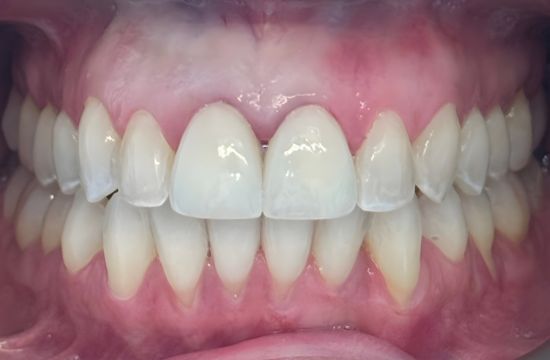 After (Teeth)