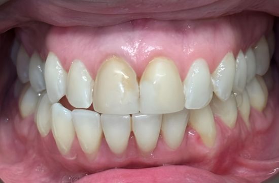 Before (Teeth)