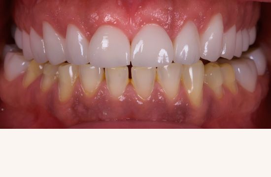 After (Teeth)