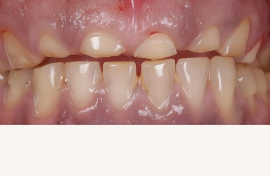 Before (Teeth)