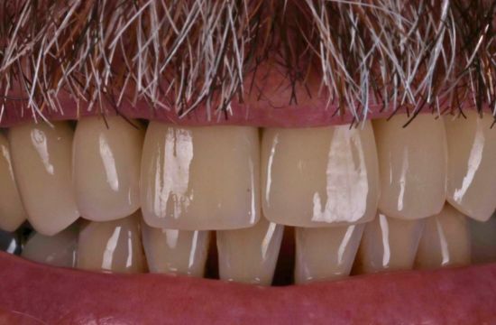 After (Teeth)