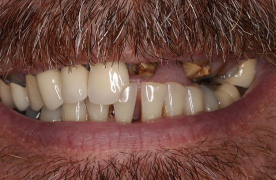 Before (Teeth)