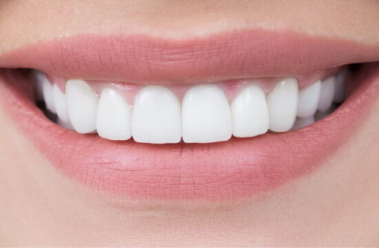 After (Teeth)