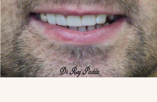 After (Teeth)