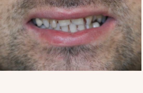 Before (Teeth)
