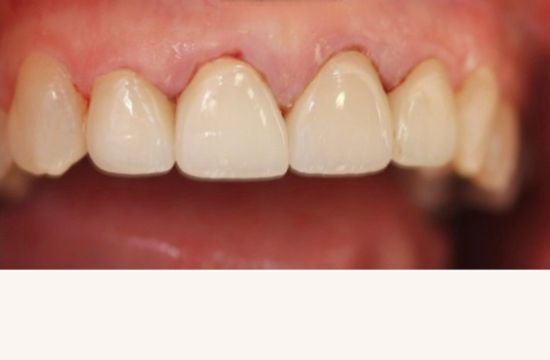 After (Teeth)
