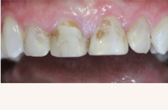 Before (Teeth)