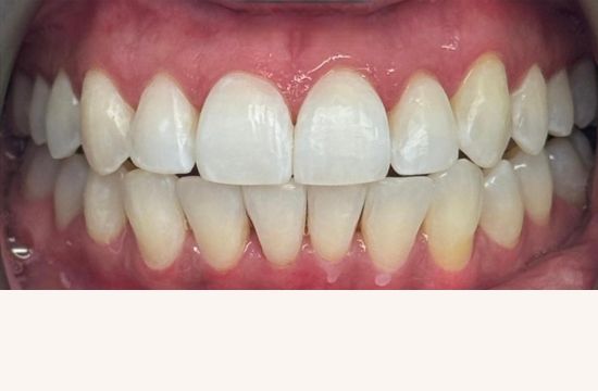 After (Teeth)
