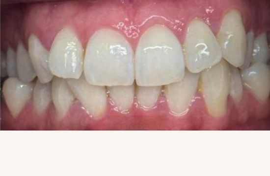 Before (Teeth)