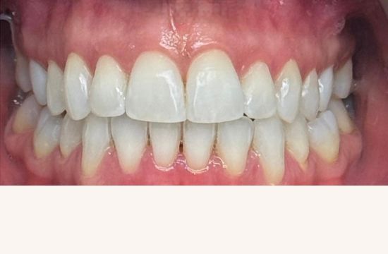 After (Teeth)