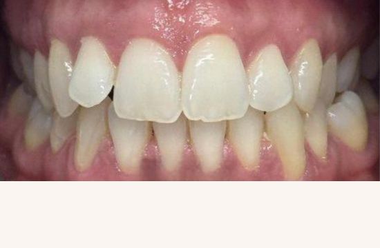 Before (Teeth)