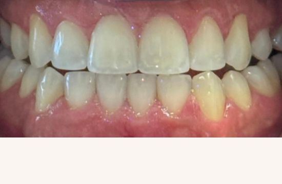 After (Teeth)