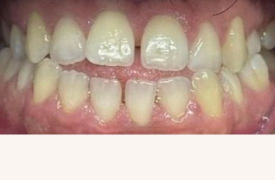 Before (Teeth)