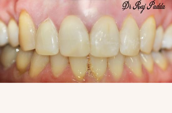 After (Teeth)