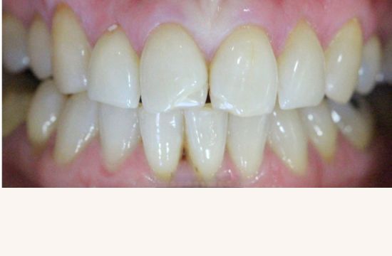 Before (Teeth)