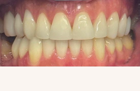 After (Teeth)