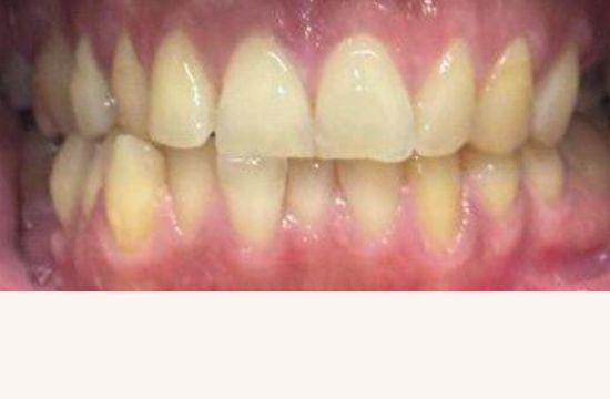 Before (Teeth)