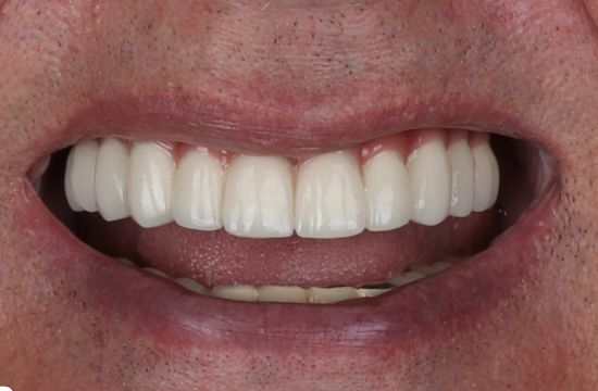 After (Teeth)