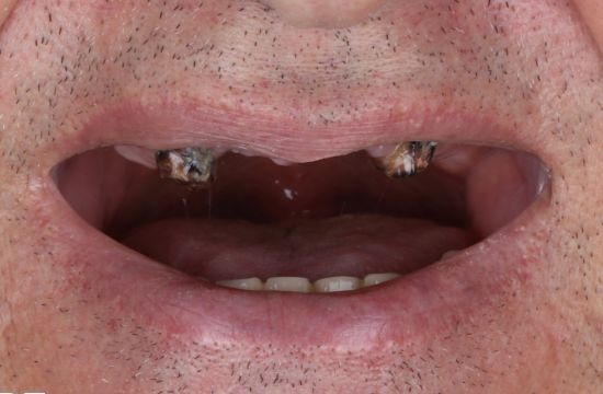Before (Teeth)